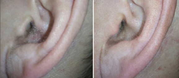 Уши с отомикозом и после лечения