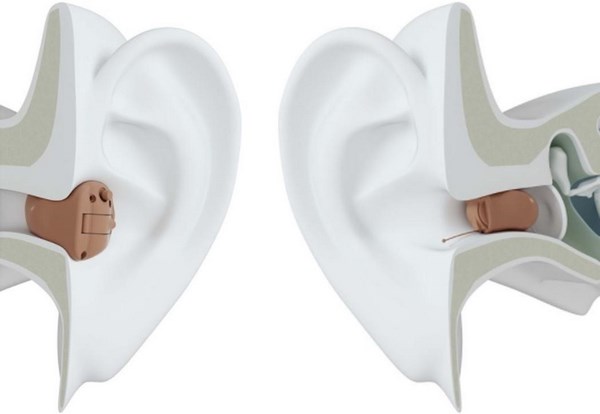 Схематично: как располагаются невидимые слуховые аппараты в ухе